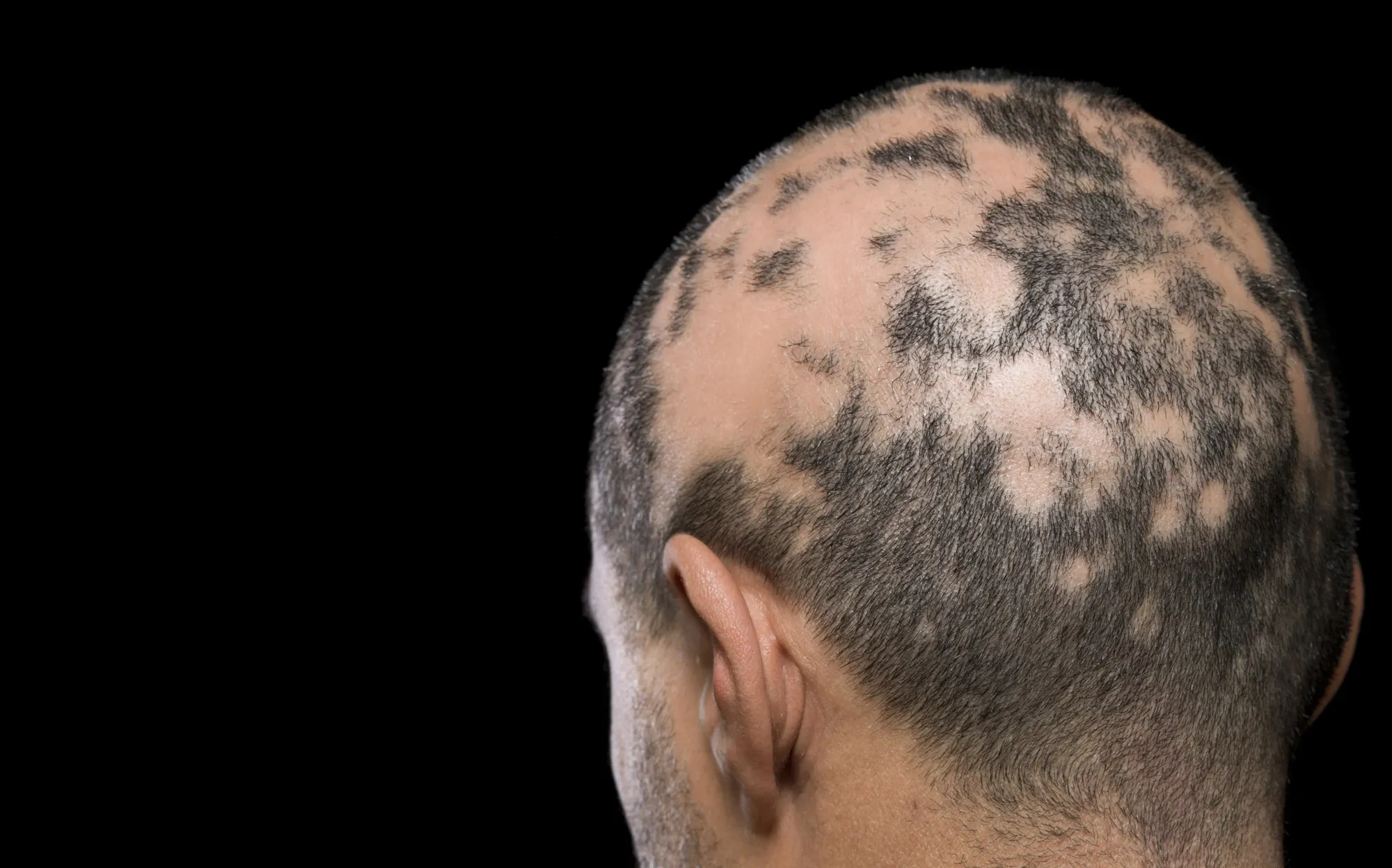 Образовательный материал - Телогеновое выпадение волос: причины, симптомы и лечение Визуальное объяснение: Алопеция