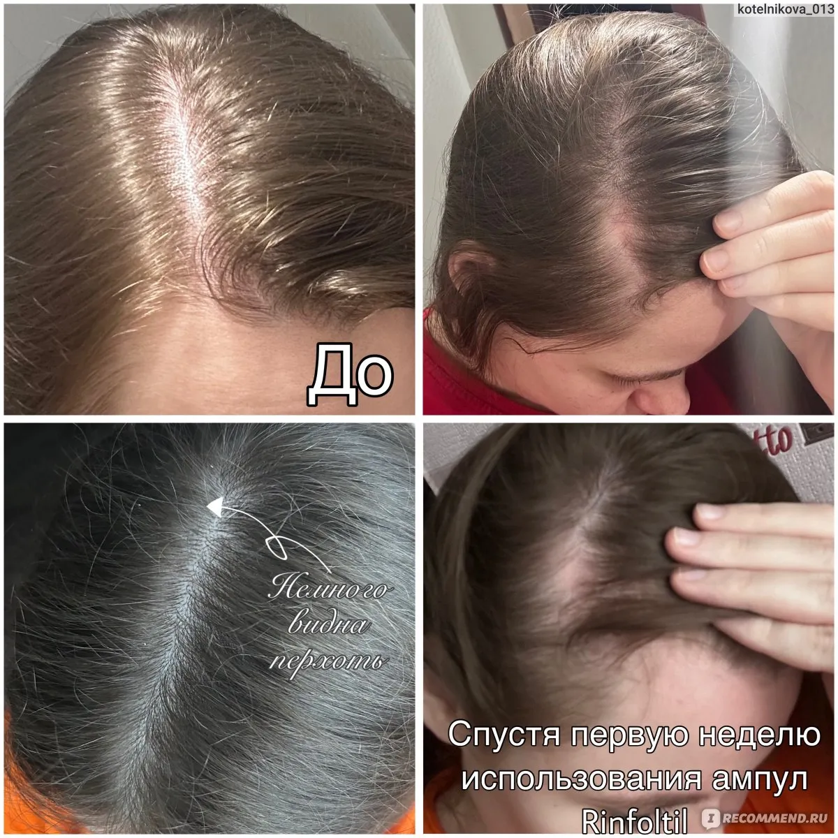 Актуальные новости: анализы при выпадении волос у женщин