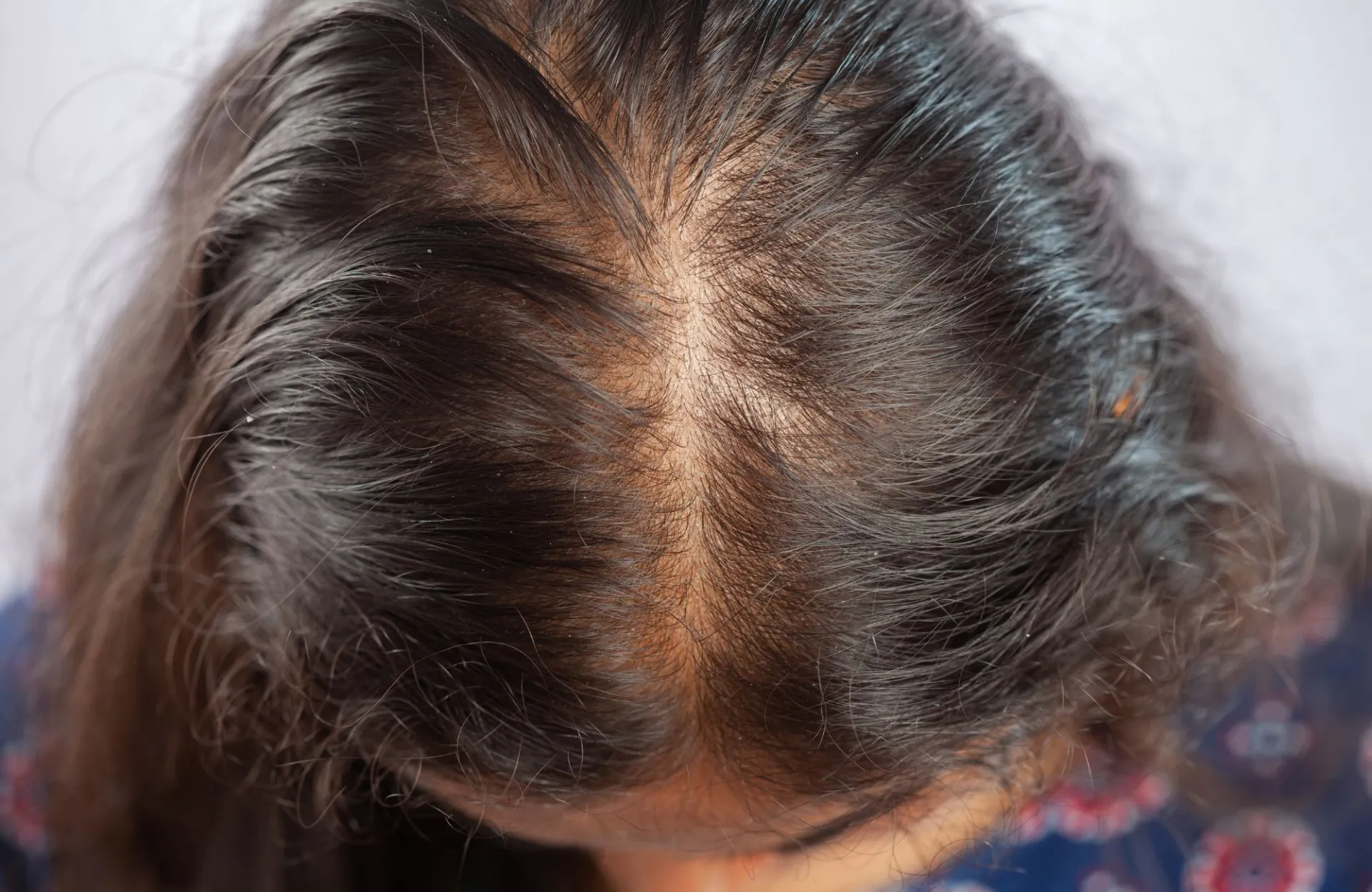 | Салон красоты | androgennaya alopetsiya 1