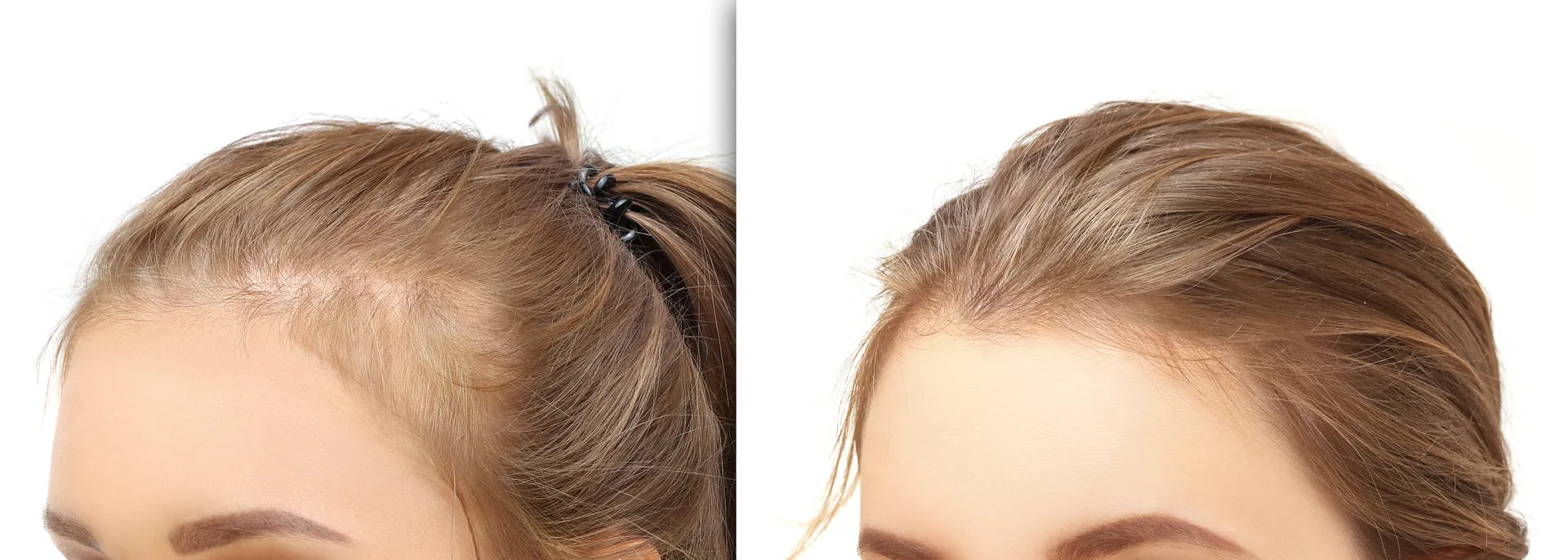 Образовательный материал - Андрогенная алопеция: причины, стадии и современные методы лечения Визуальное объяснение: андрогенная алопеция у женщин