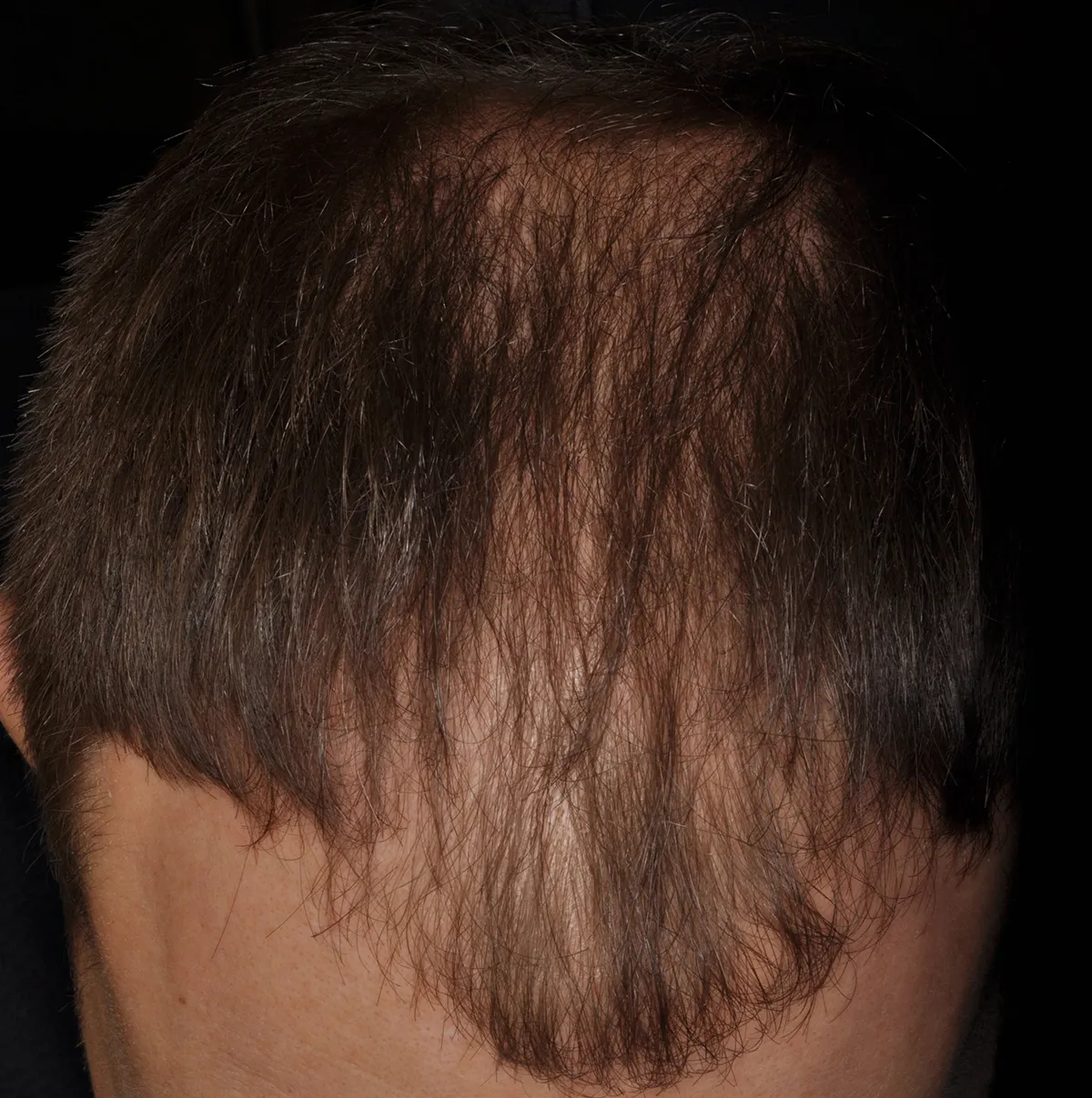 Актуальные новости: андрогенная алопеция