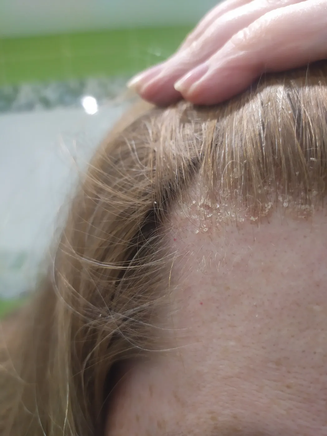 Образовательный материал - Лечение кожи головы: симптомы, причины и эффективные методы Визуальное объяснение: чем лечить кожу головы