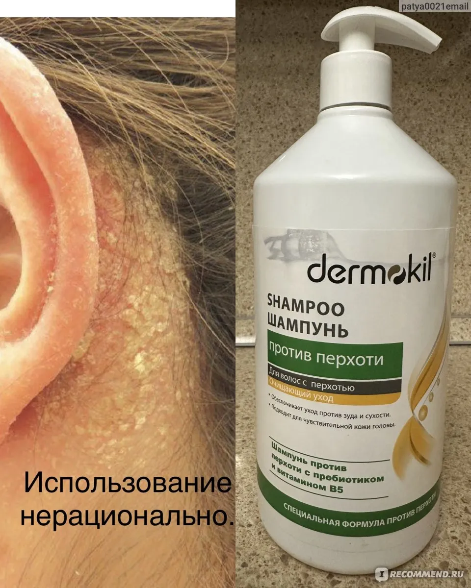 Актуальные новости: чем лечить перхоть