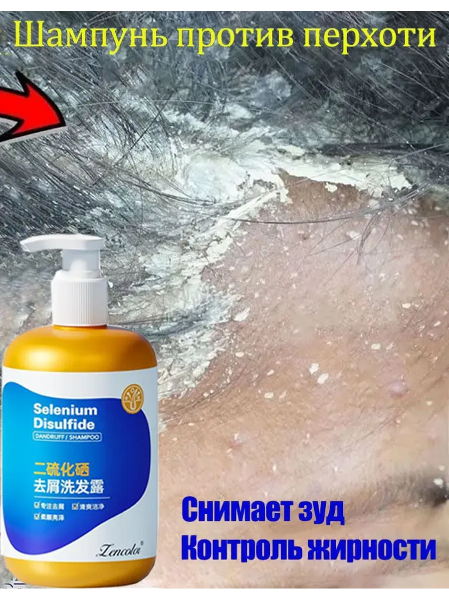 Актуальные новости: чем лечить себорею