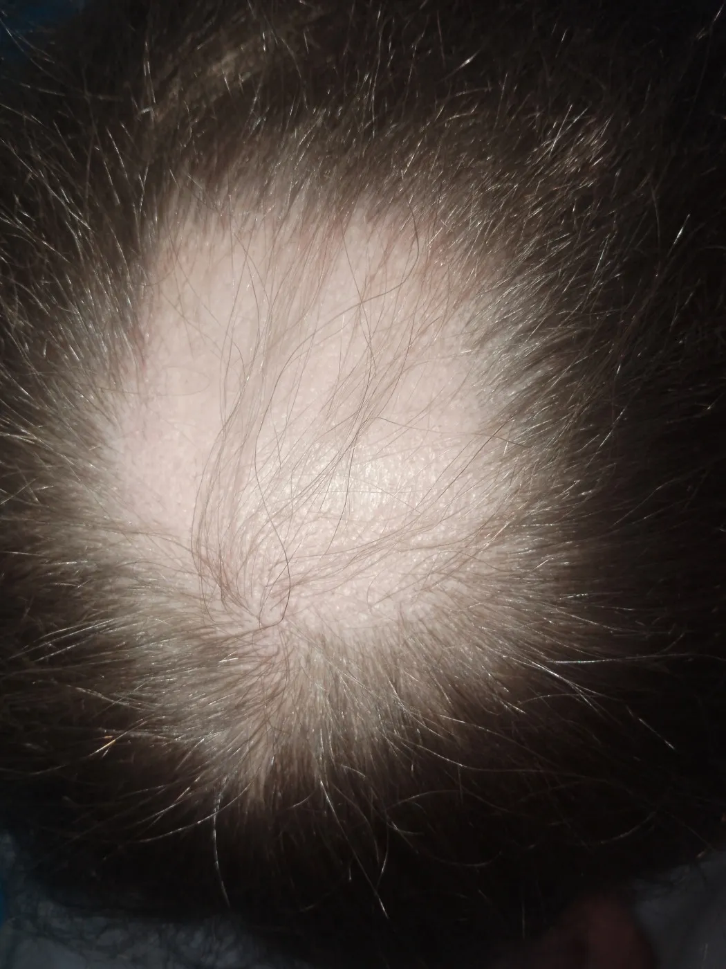 Визуальное объяснение: гнездная алопеция