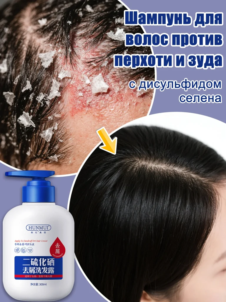 Уход за волосами и кожей головы — как избавиться от перхоти