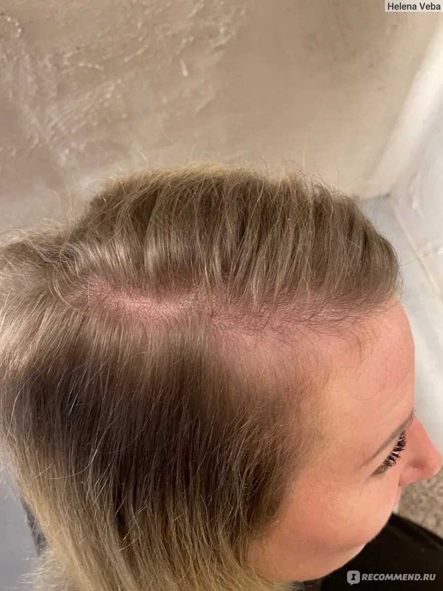 Визуальное объяснение: как остановить выпадение волос