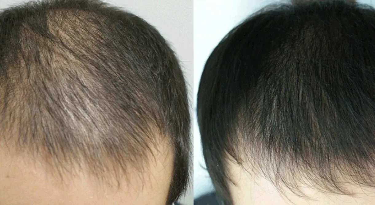 Визуальное объяснение: лечение алопеции у женщин