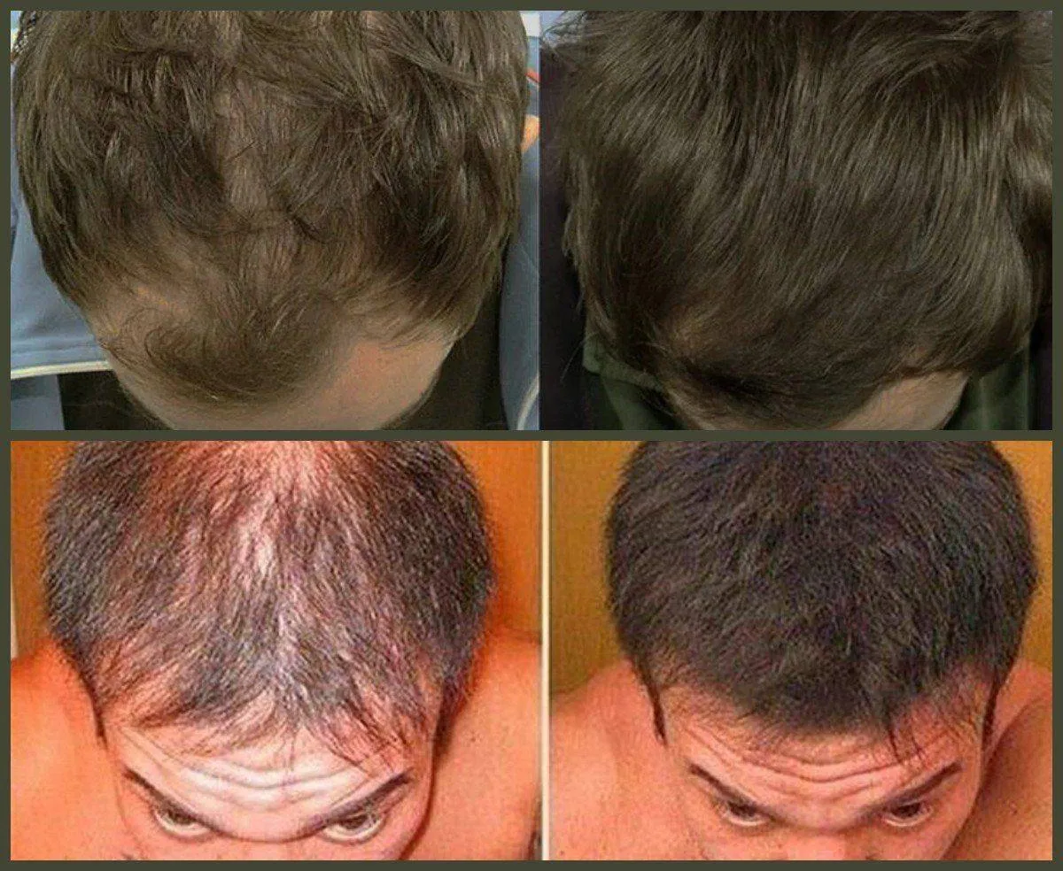 Визуальное руководство по: лечение андрогенной алопеции