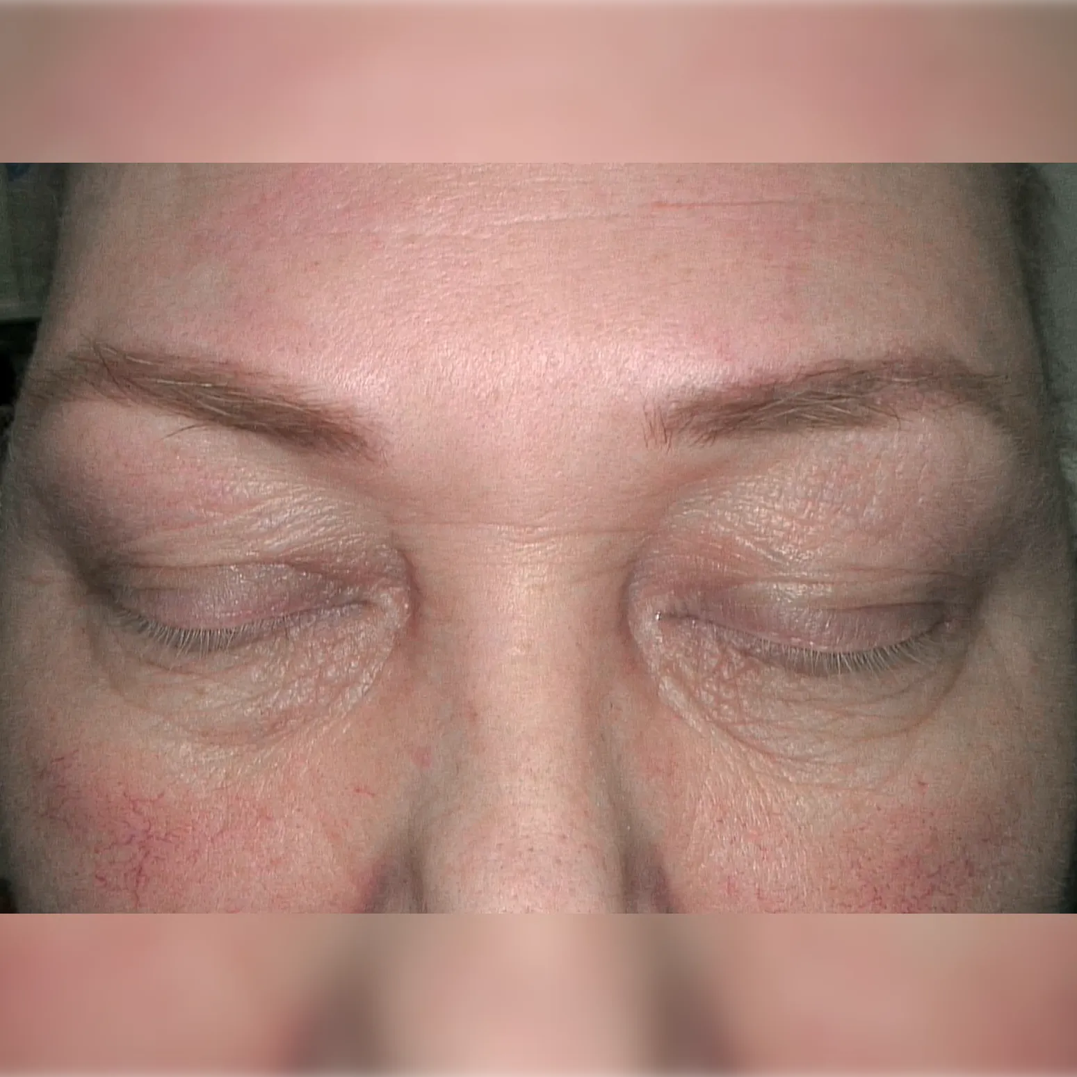 Актуальные новости: лечение облысения