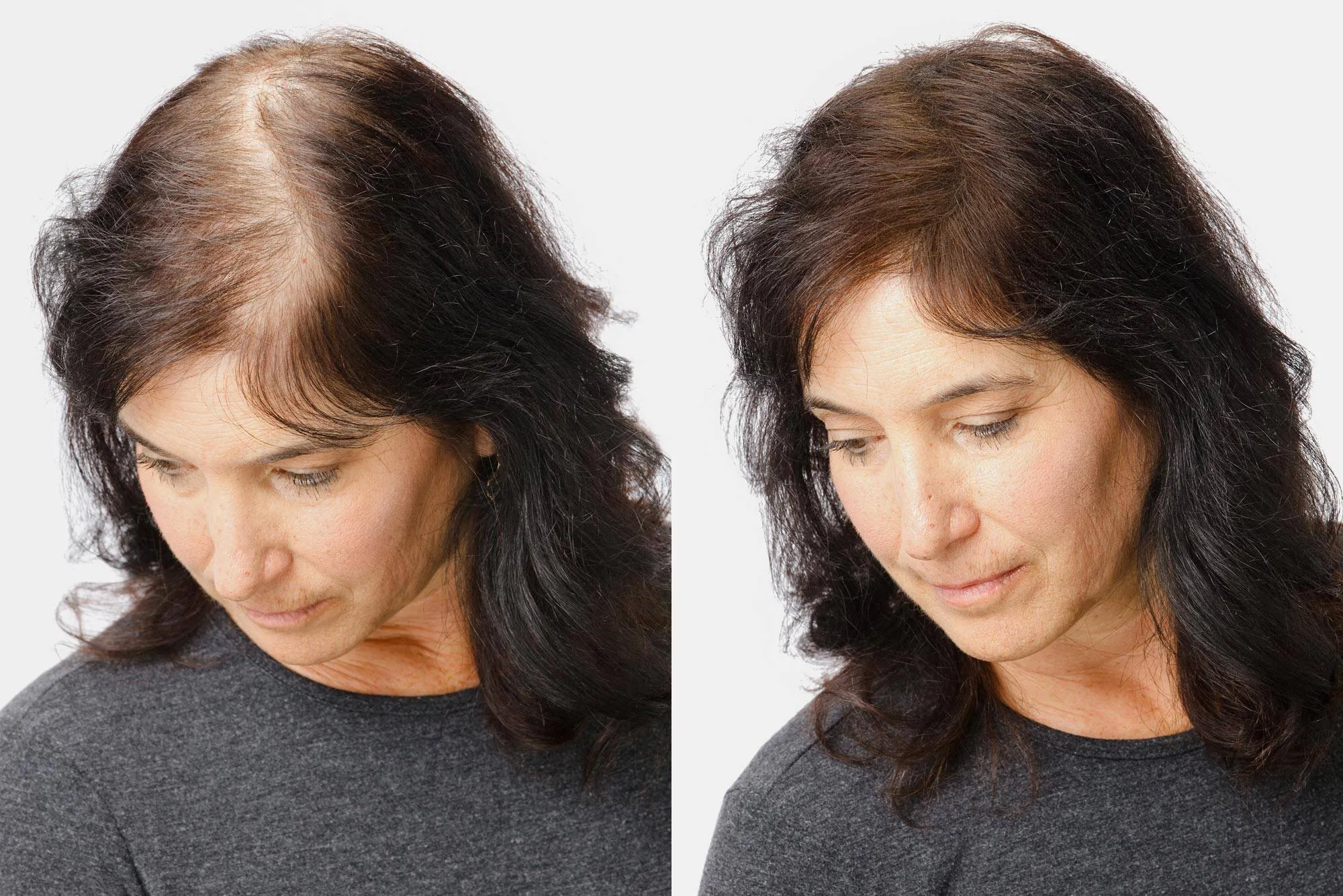 Визуальное объяснение: облысение у женщин