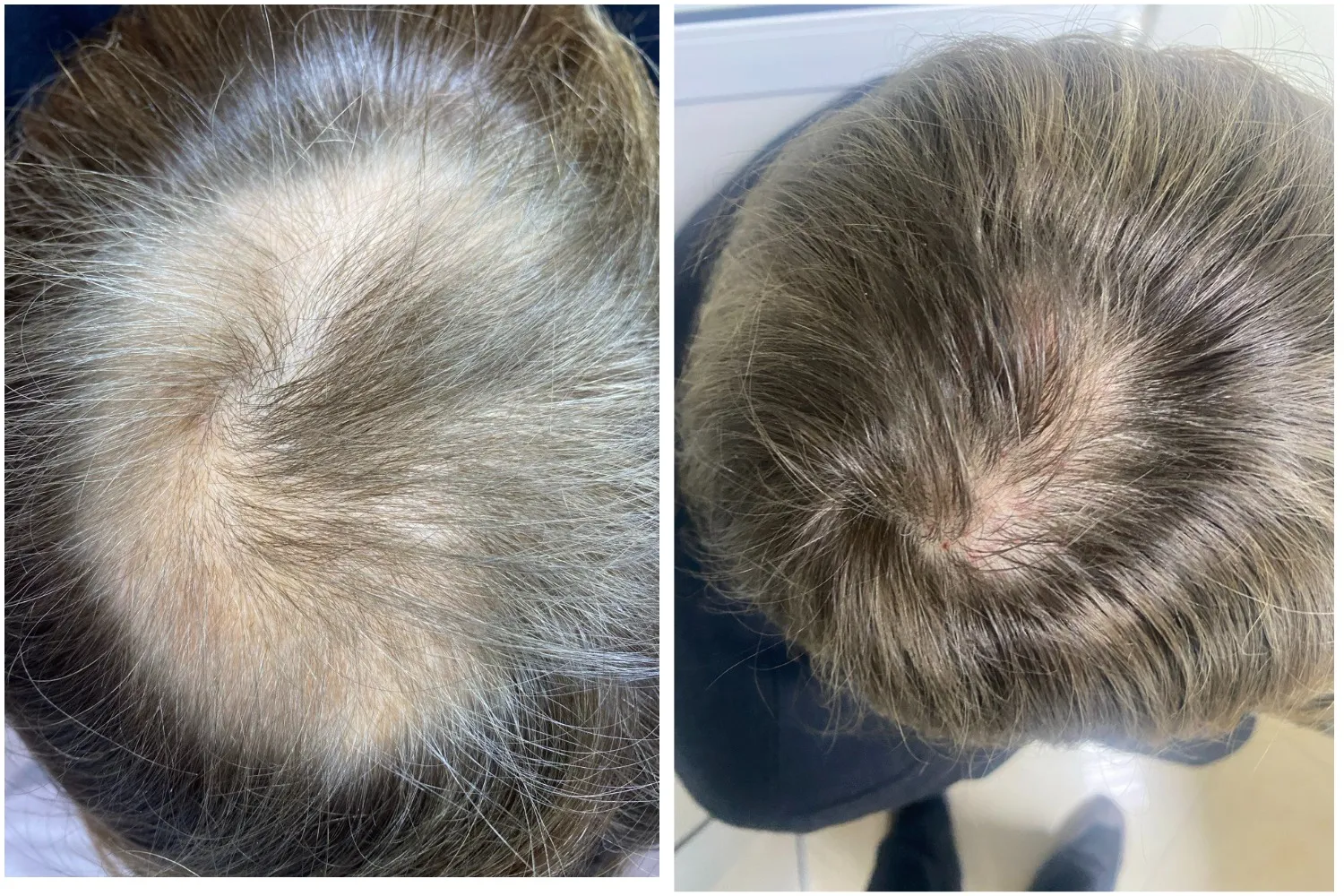 Визуальное руководство по: очаговая алопеция