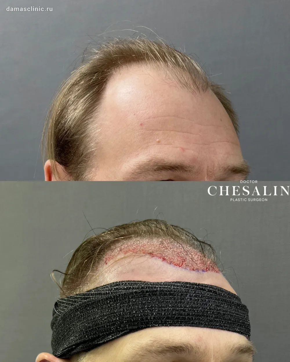 Актуальные новости: пересадка волос цена