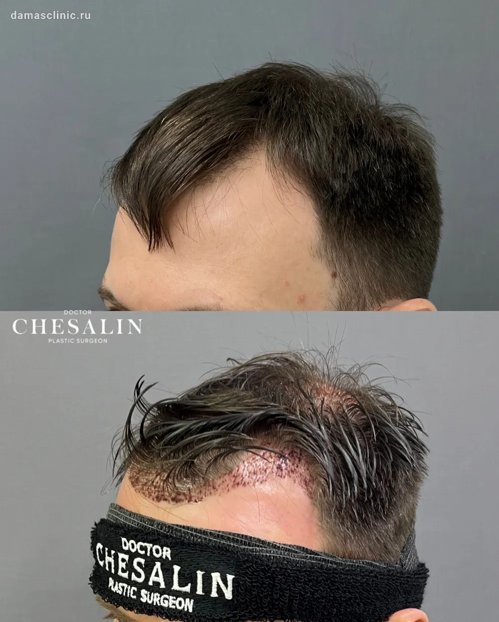 Актуальные новости: пересадка волос