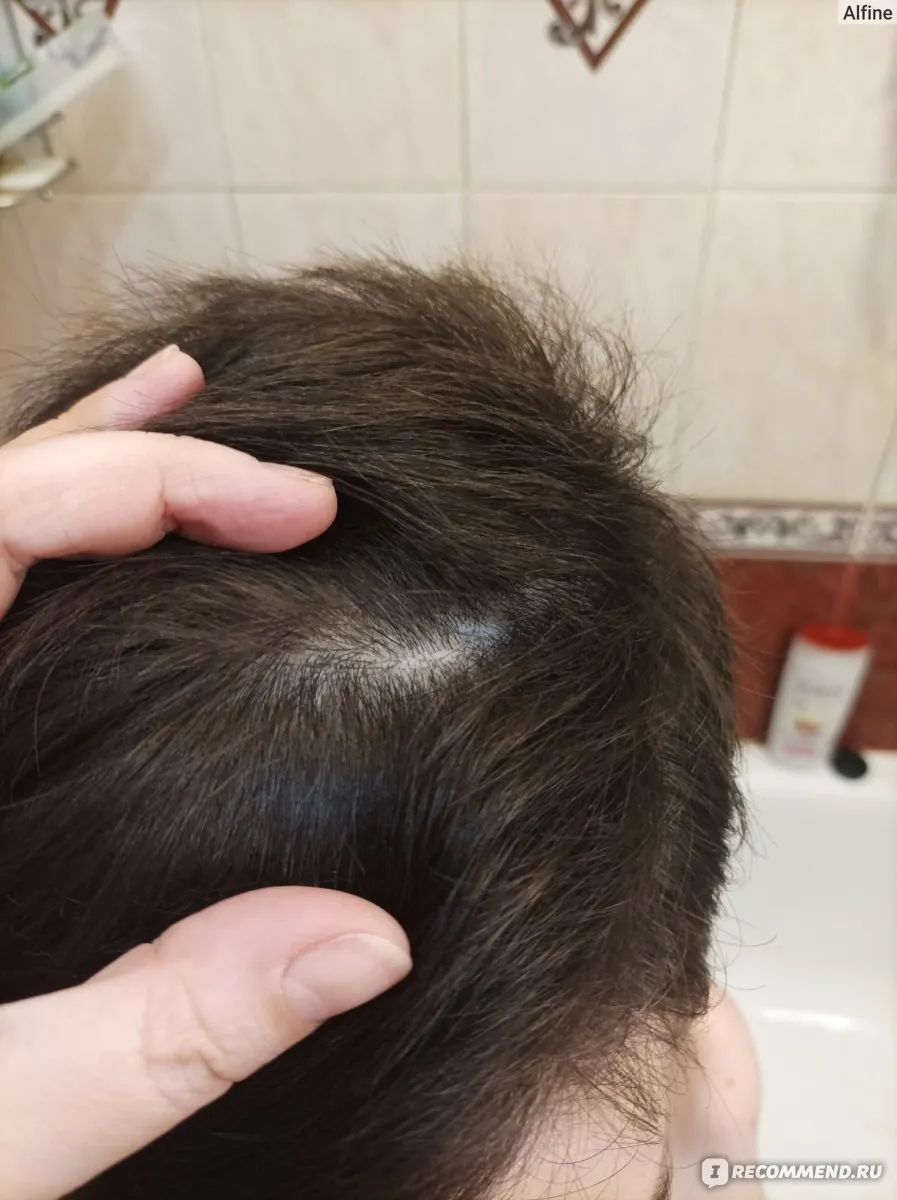 Практическое руководство - Перхоть: причины, лечение и профилактика | Объективное руководство Визуальное руководство по: перхоть что делать