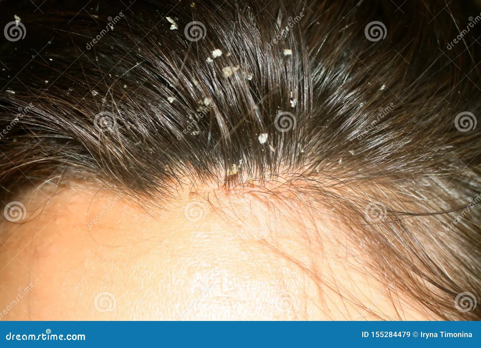 Крупный план кожи головы с признаками перхоти и покраснения, визуализация проблемы зуда и шелушения
