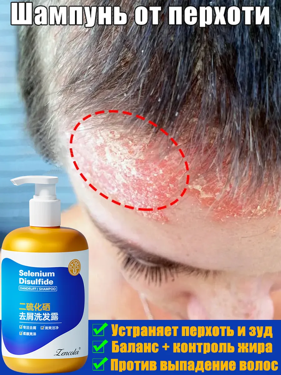 Визуализация проблемы перхоти и зуда кожи головы: сравнение здоровой и раздраженной кожи, микроскопическое изображение грибка Malassezia