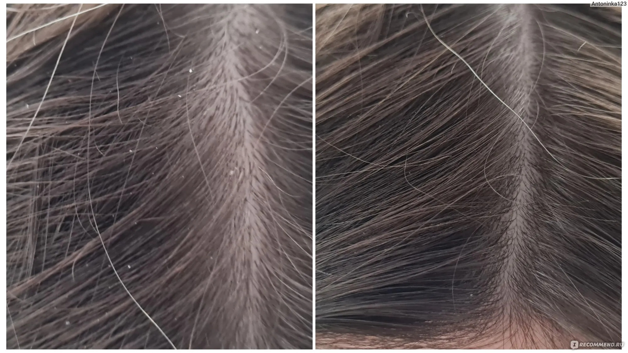 Визуальное руководство по: перхоть отзывы