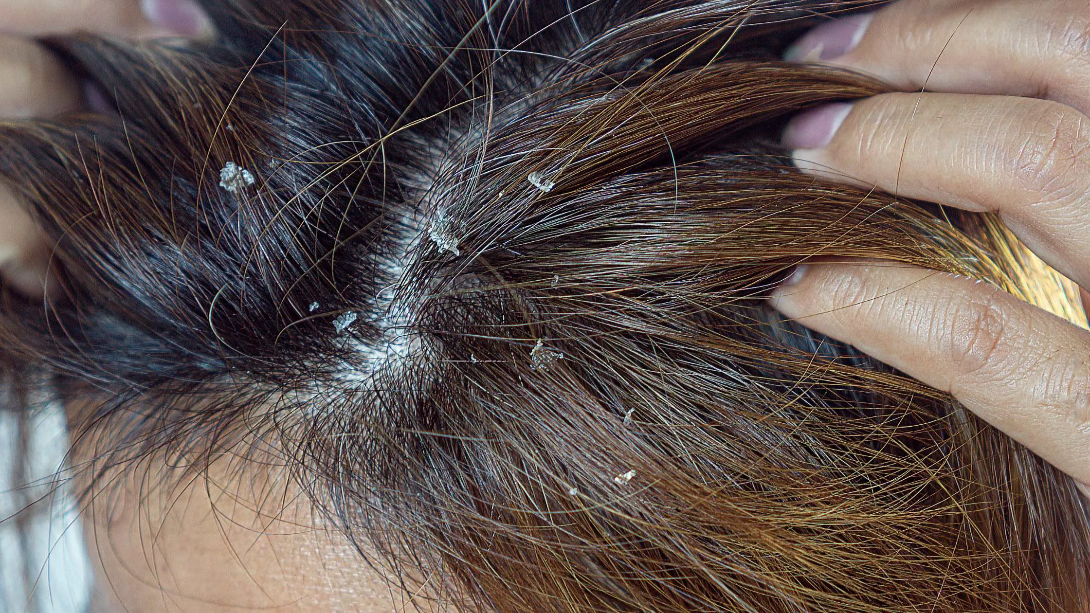 Актуальные новости: перхоть у подростков