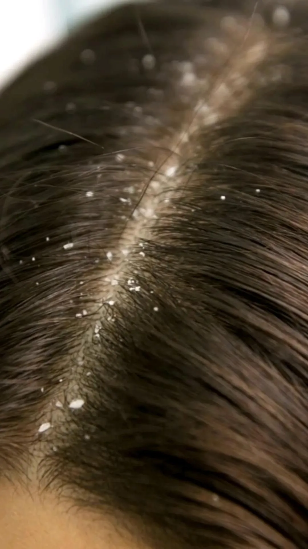 Визуальное объяснение: перхоть у женщин