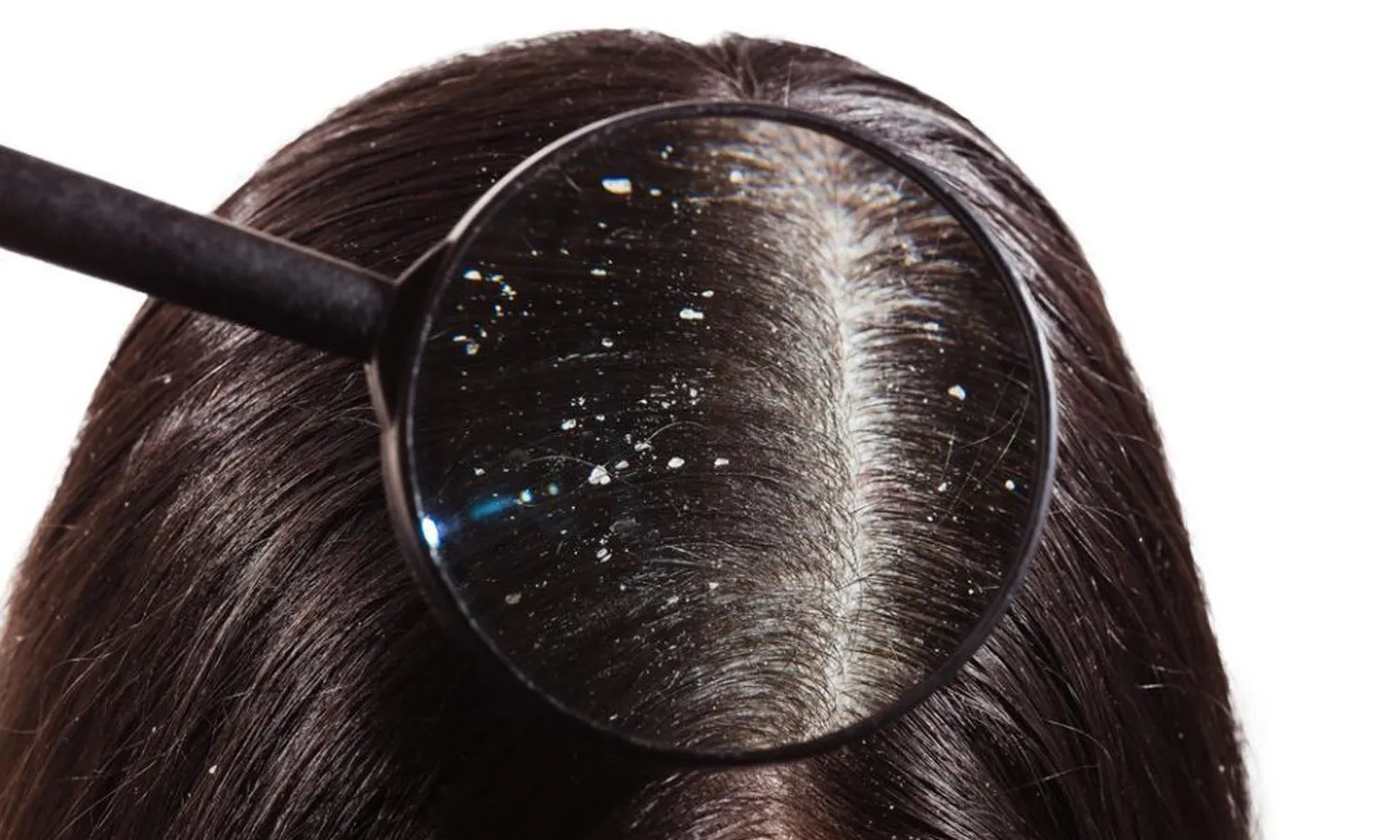 Лечение перхоти народными средствами и уход в домашних условиях Эффективные методы лечения перхоти в домашних условиях с использованием натуральных средств