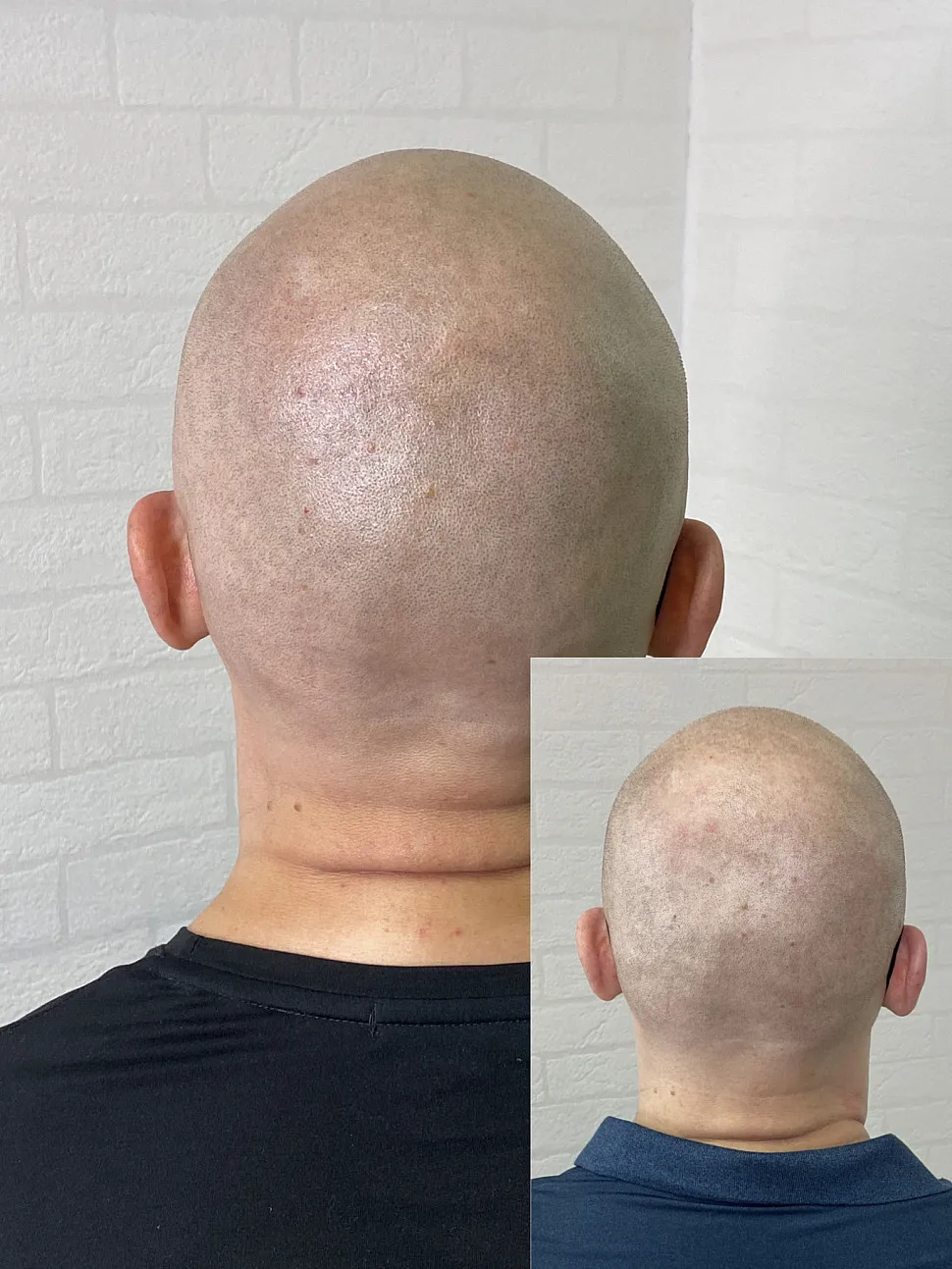 Визуальное руководство по: рубцовая алопеция