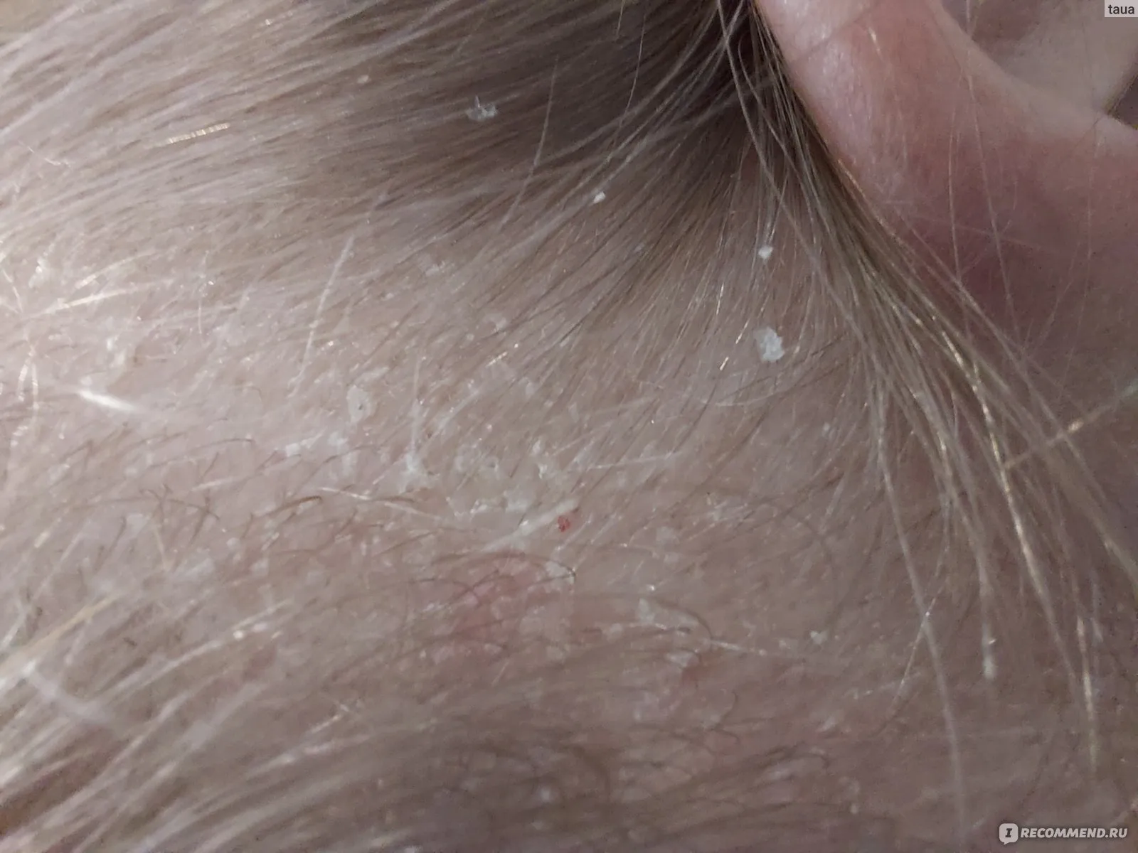 Актуальные новости: себорея кожи головы