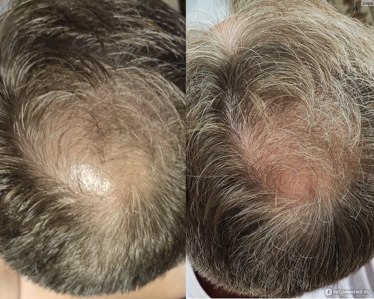| Салон красоты | silnoe vypadenie volos 1