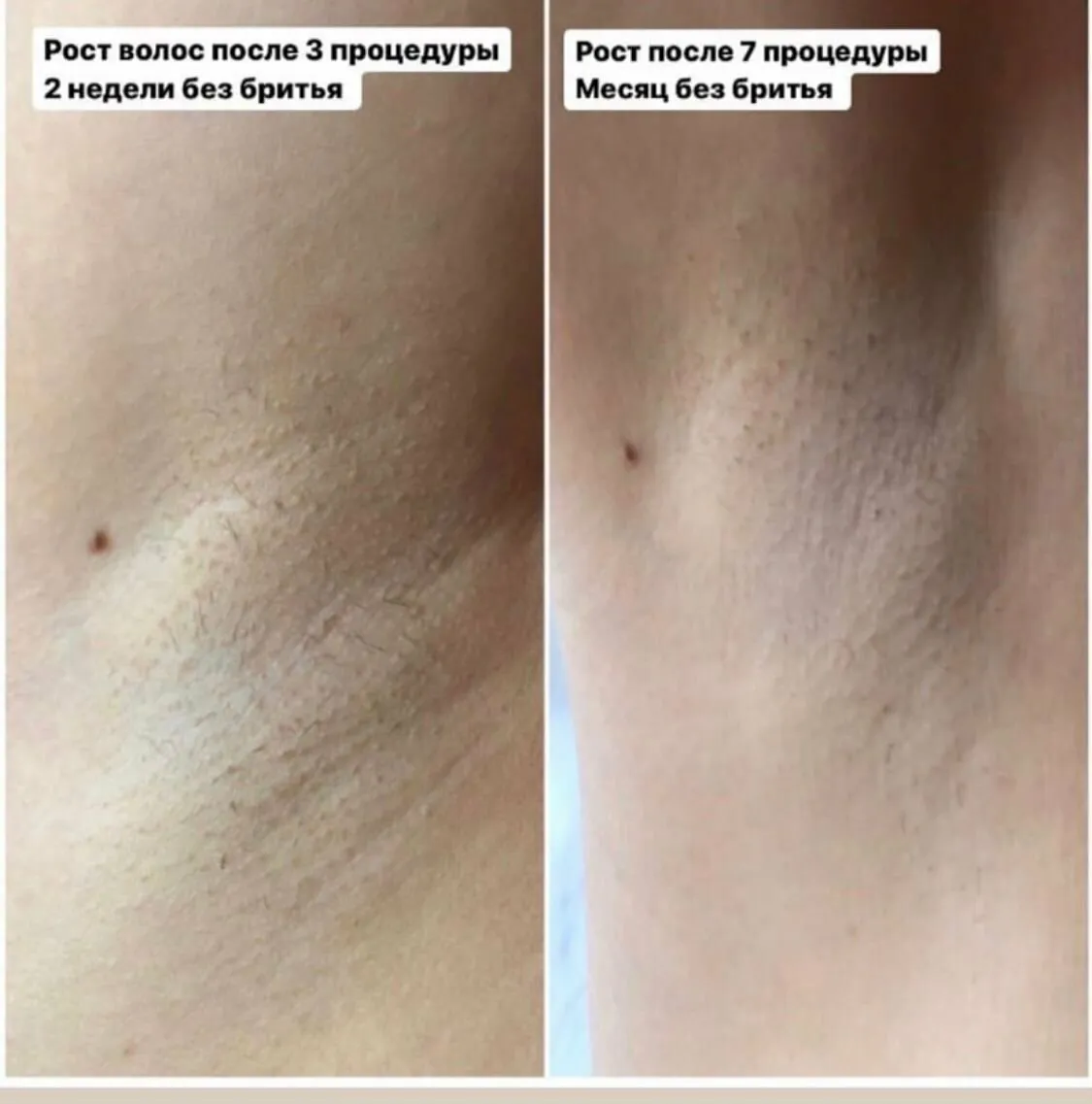 Практическое руководство - Фазы роста волос: просто о сложном цикле жизни волоса Визуальное руководство по: сколько растут волосы