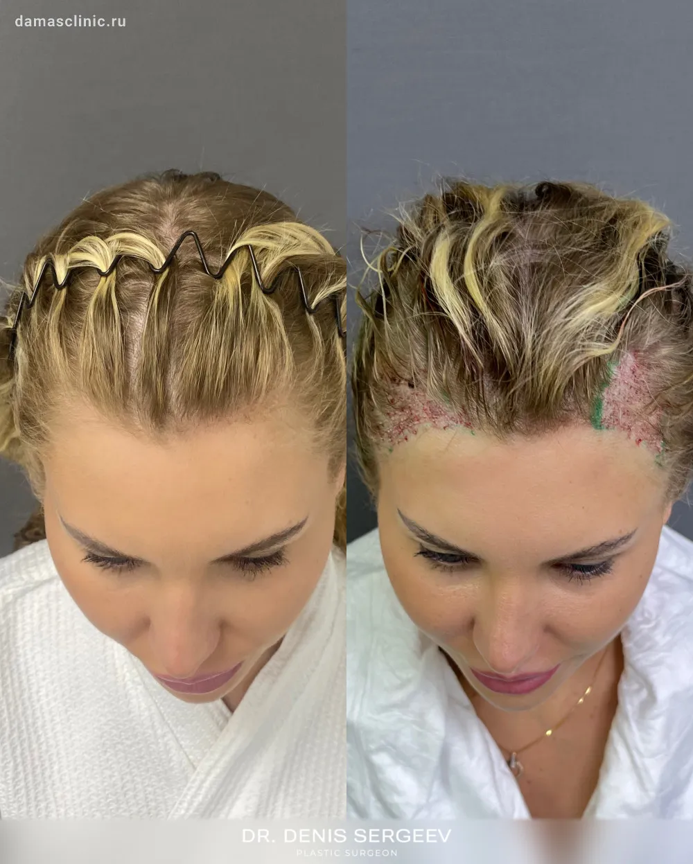 Актуальные новости: стоимость пересадки волос