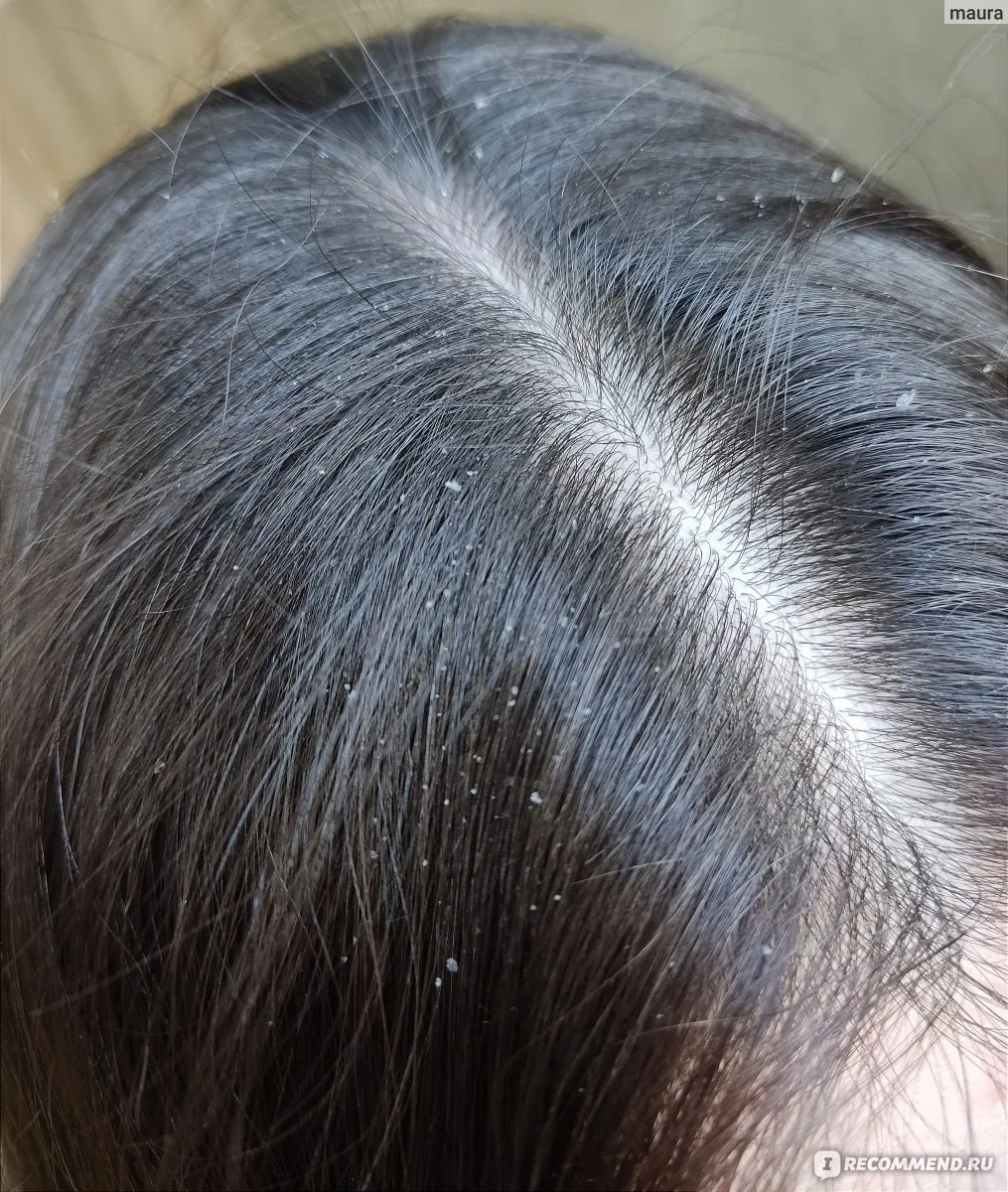 Актуальные новости: сухая кожа головы что делать