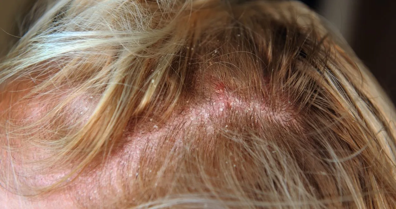 Визуальное руководство по: сухая себорея