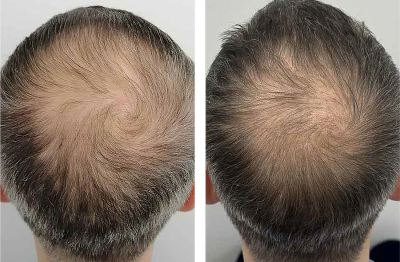 Схематичное изображение фазы телогена при диффузной алопеции, показывающее переход волосяных фолликулов в состояние покоя