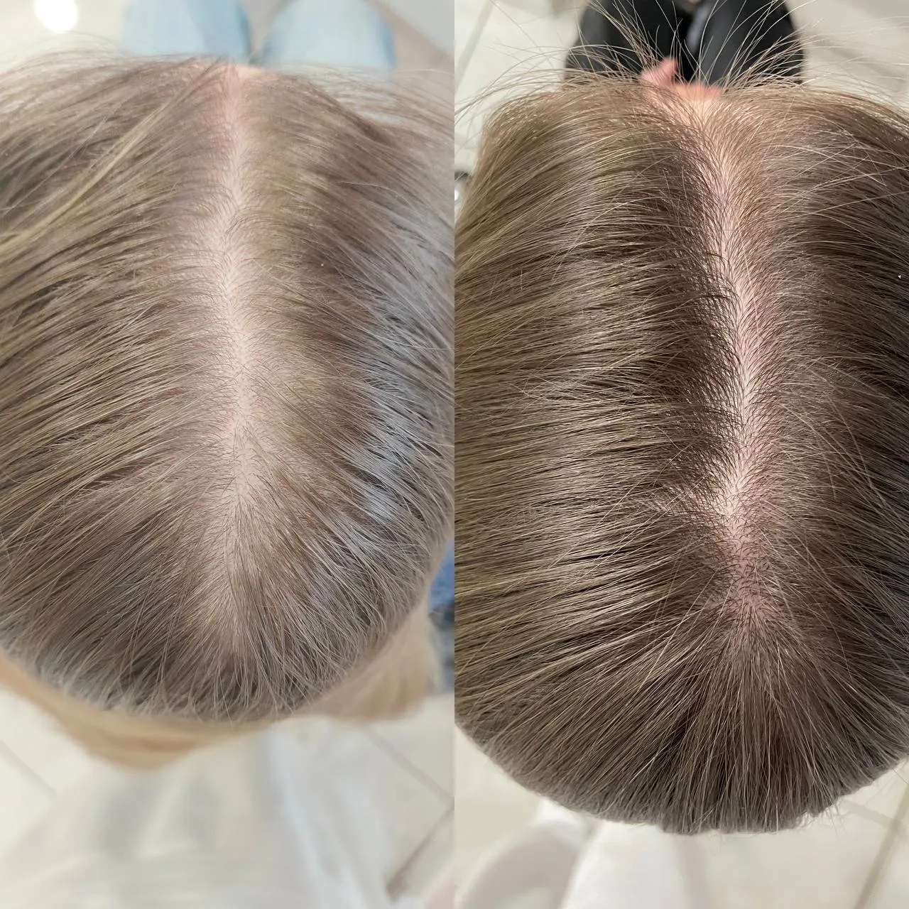 Механизм развития телогенового выпадения волос Схематичное изображение фазы телогена при выпадении волос, показывающее переход волосяных фолликулов в состояние покоя