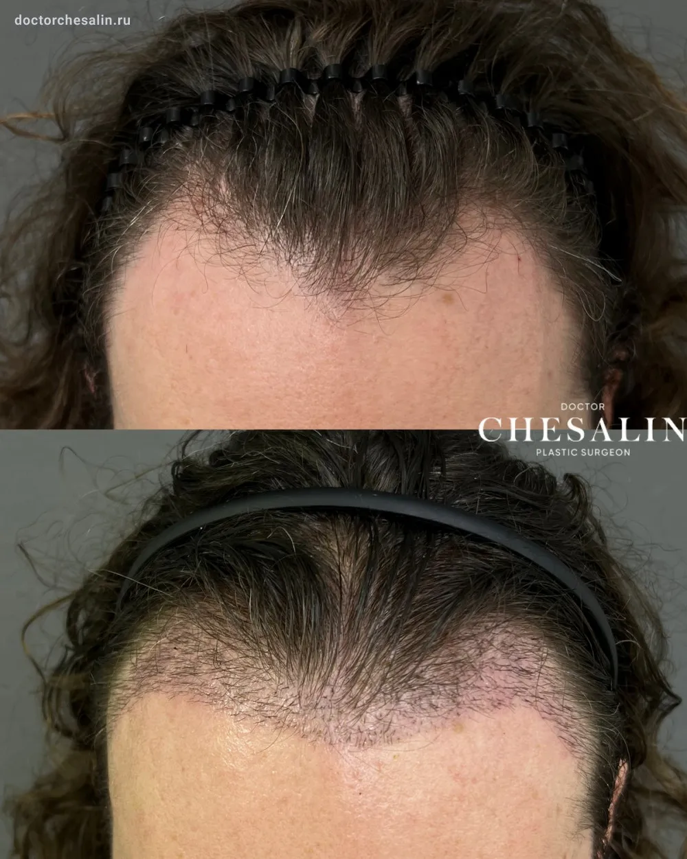 Актуальные новости: трансплантация волос