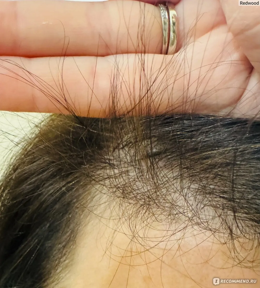 Практическое руководство - Телогеновое выпадение волос: причины, симптомы и лечение Визуальное руководство по: Выпадение волос