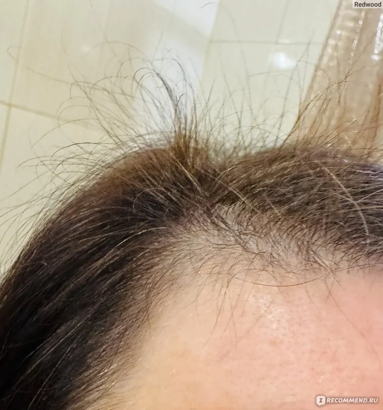 Здоровье волос — Выпадение волос