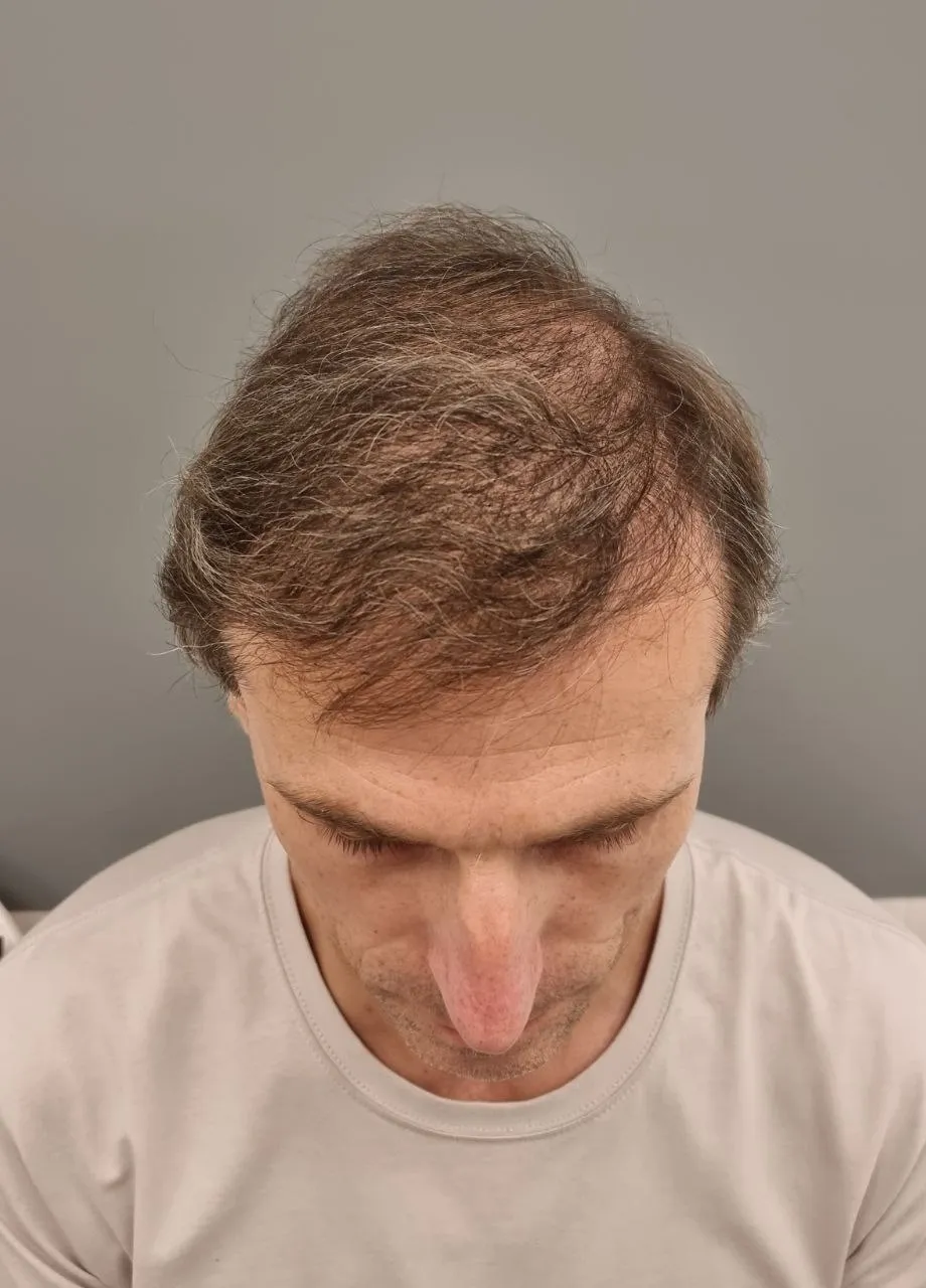 Актуальные новости: выпадение волос у мужчин