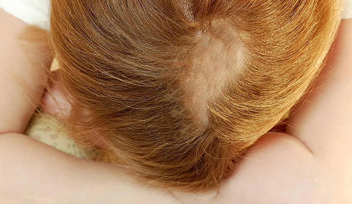 Визуальное объяснение: выпадение волос у ребенка