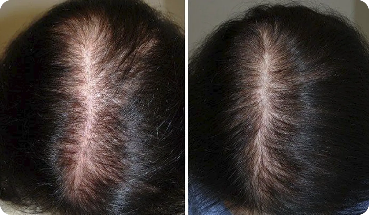 Визуальное руководство по: Выпадение волос у женщин. Техника нанесения сыворотки и массажа кожи головы при телогеновом выпадении.