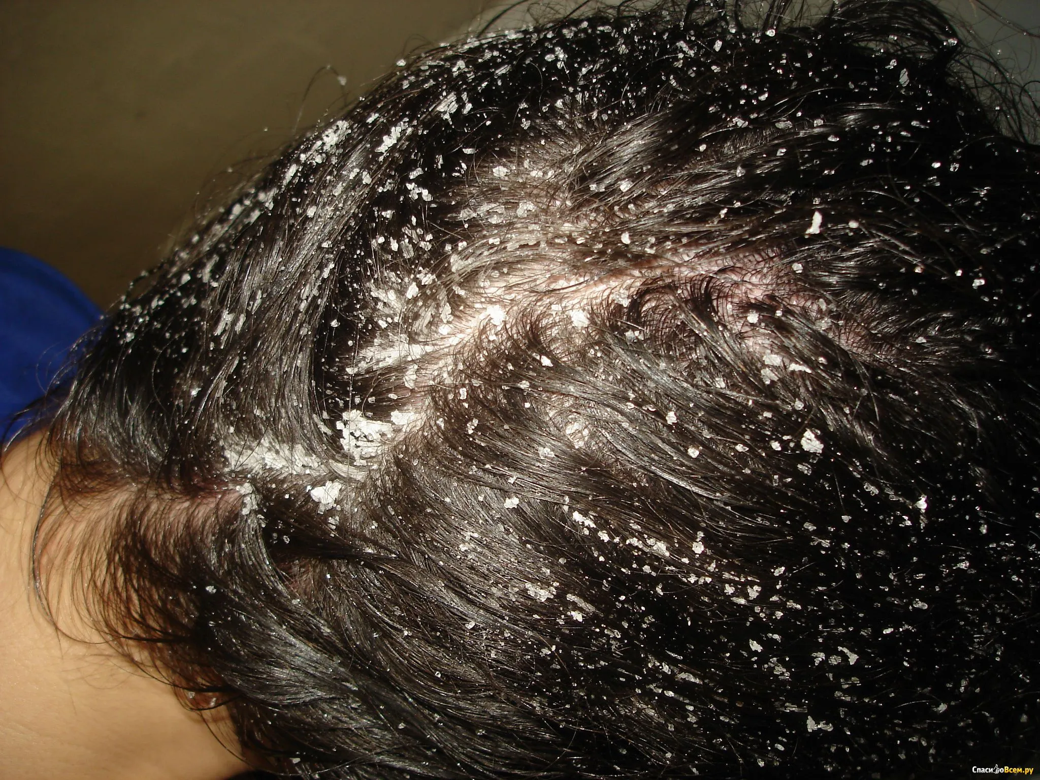 Визуальное объяснение: жирная себорея