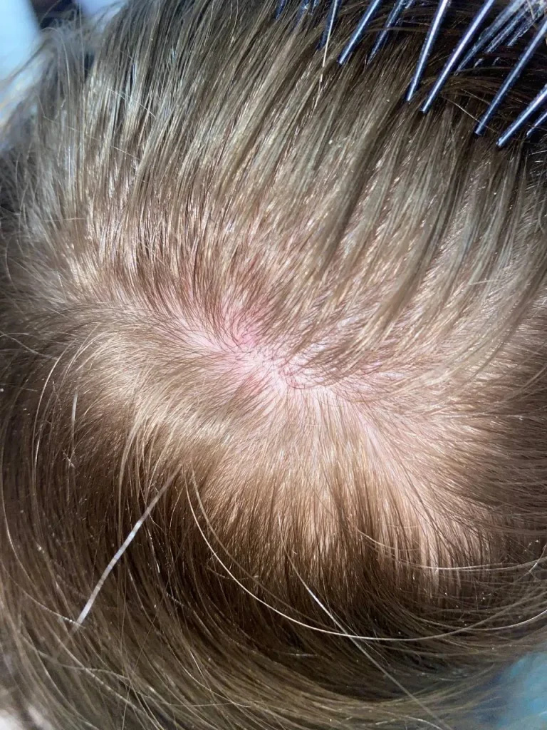 Здоровье и уход — зуд кожи головы