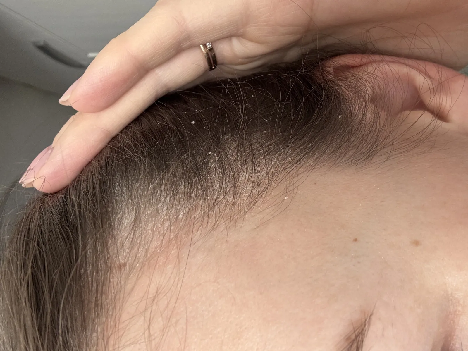 Причины и лечение зуда кожи головы: фото с изображением здоровой и раздраженной кожи, схемы ухода