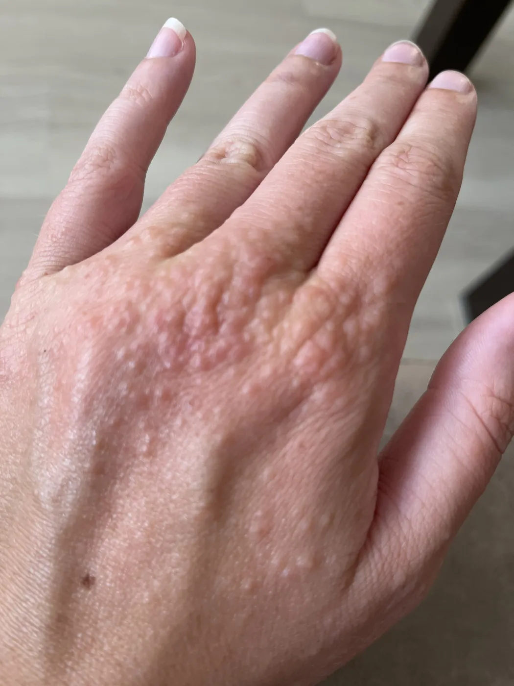 Визуальное объяснение: атопический дерматит на руках