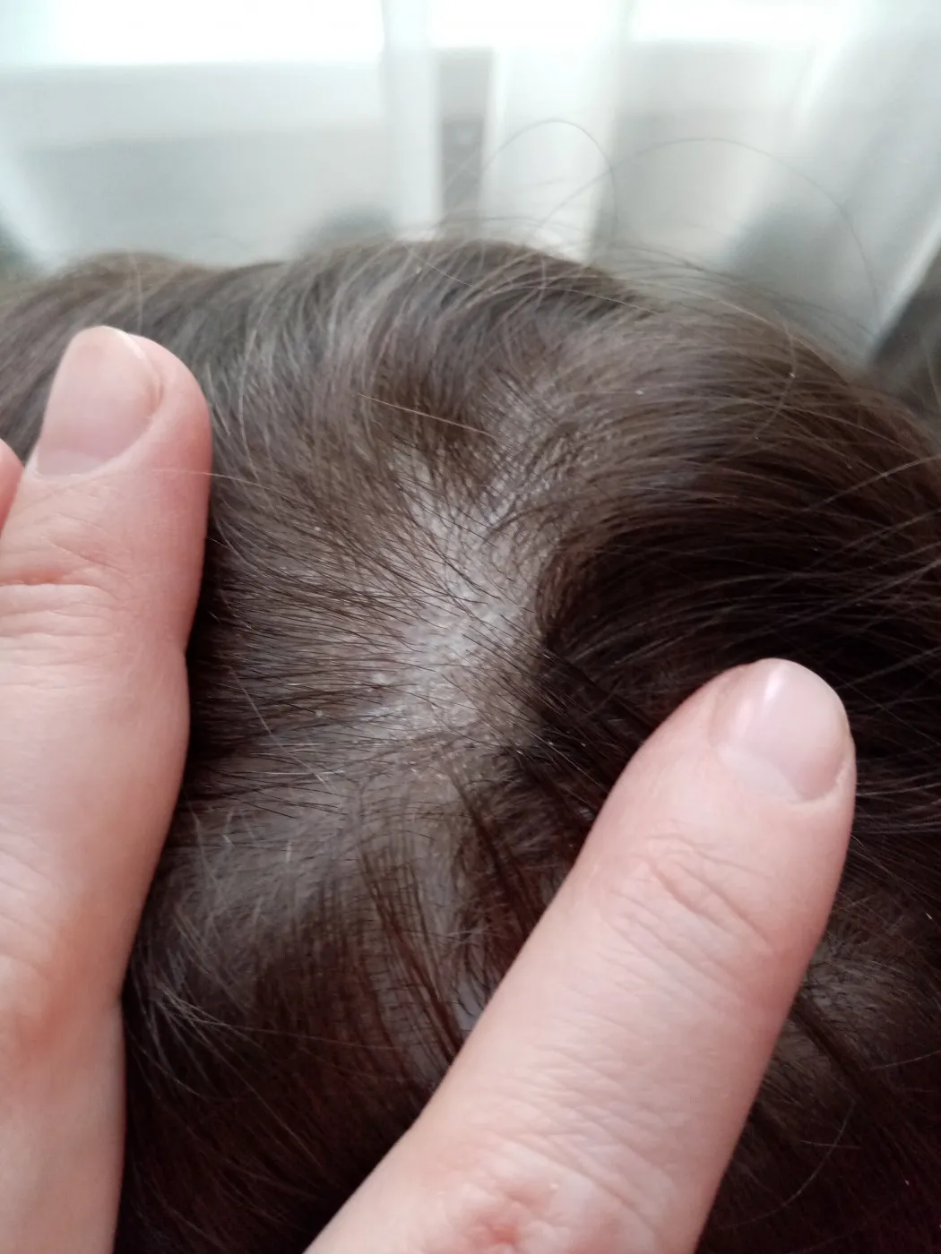 Визуальное руководство по: перхоть как вылечить