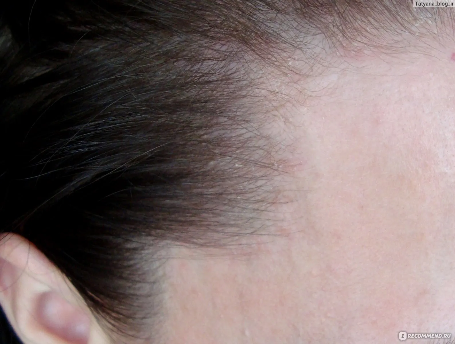 Образовательный материал - Шелушение кожи: причины, лечение и профилактика | Обзор методов Визуальное объяснение: шелушение кожи головы