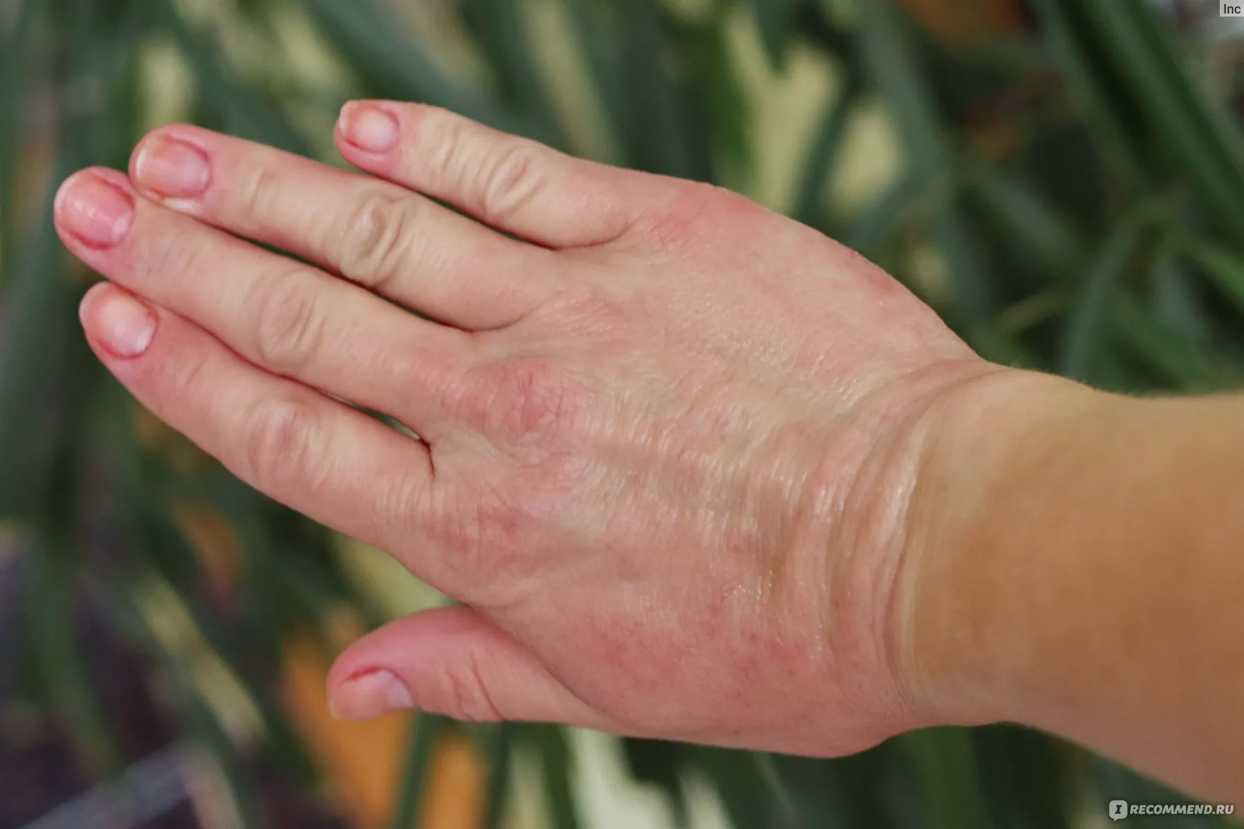 Актуальные новости: сухая кожа и зуд