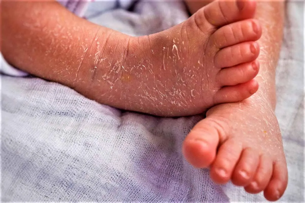 Актуальные новости: сухость и шелушение кожи