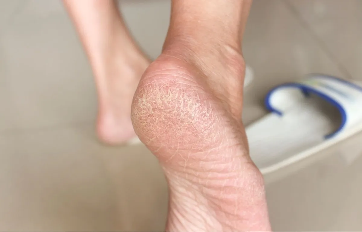 Актуальные новости: сухость кожи