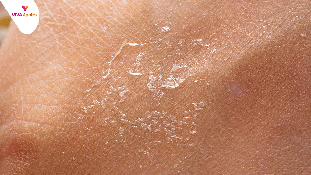 Визуальное объяснение: сухость кожи лица